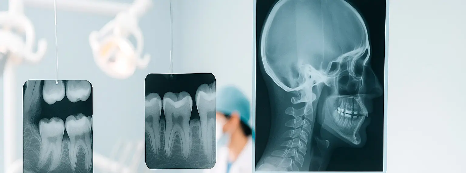 Radiografía bitewing interproximal en RX San Miguel